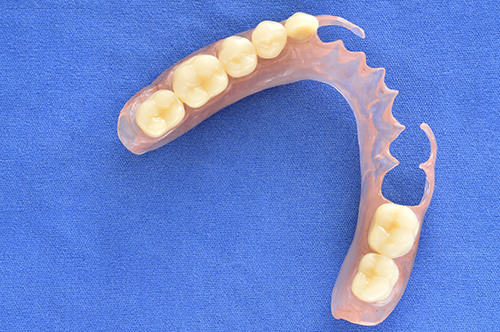 Removable Dental Bridges in Huntington