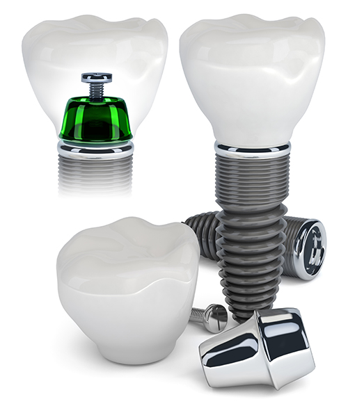 Huntington Implant Dentist