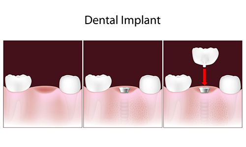 Dental Implants in Huntington