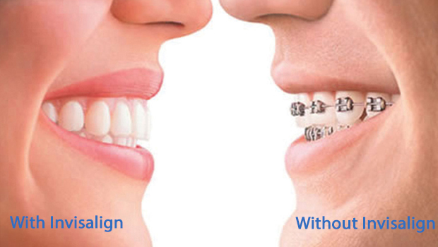 Invisalign in Huntington