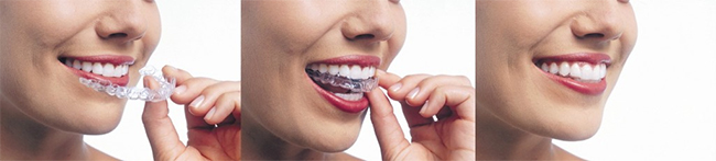 Huntington Invisalign