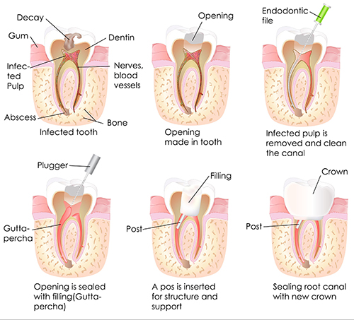 Root Canal Therapy in Huntington