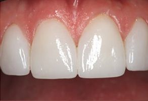 Barboursville Before and After Invisalign